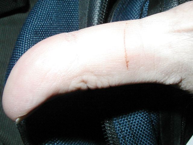 Papercut on Thumb